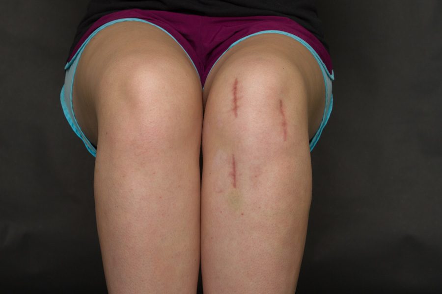 Anderson displays the surgical scars on her knee. After being kicked during a soccer game, Anderson had reconstructive surgery, and may not be able to play soccer again.